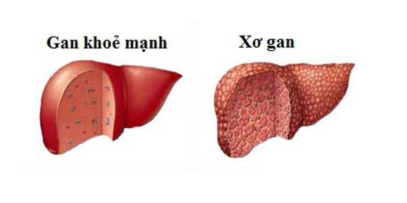 Bệnh xơ gan