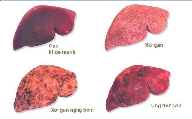 Cây an xoa phòng ngừa và hỗ trợ điều trị ung thư gan